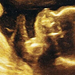 Ultrasonido de un feto