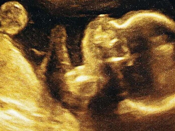 Ultrasonido de un feto